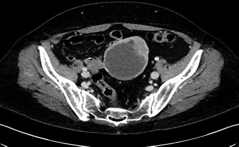 An Axial View Of The Patients Pelvis On Ct Scan Showing A Large
