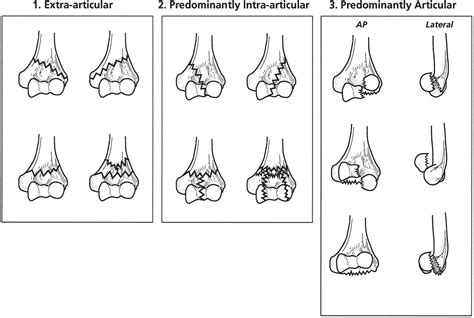 A Clinically Applicable Fracture Classification For Distal Humeral