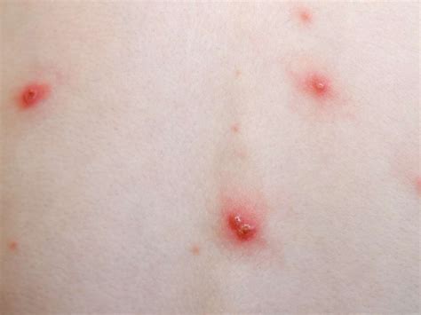 Internal Shingles What To Know About Shingles Without A Rash