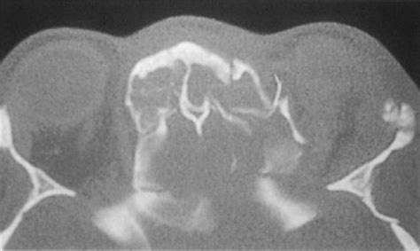 Nasoethmoid Fractures | Pocket Dentistry
