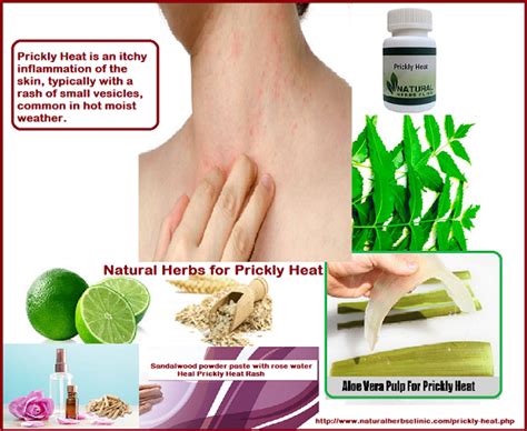Herbal Remedies For Prickly Heat Cause Symptoms Treatment Natural