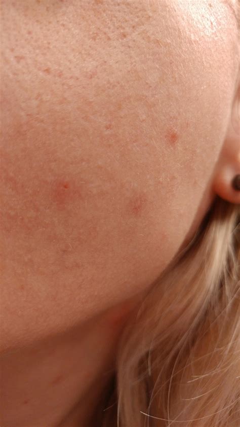 Acne Closed Comedones Sebaceous Filaments What Is On My Face And How Do I Get Rid Of Them