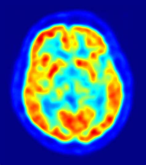 Pet Imaging With Special Tracer Can Detect And Diagnose Early Alzheimer