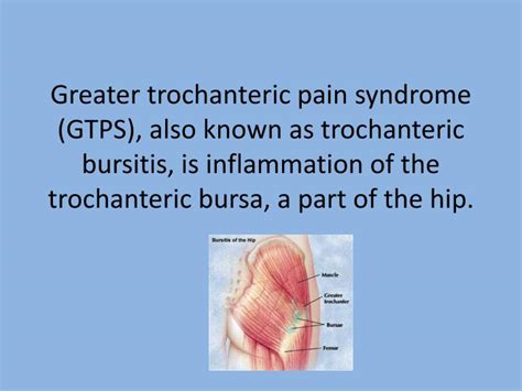 Ppt Greater Trochanteric Pain Syndrome Gtps Also Known As
