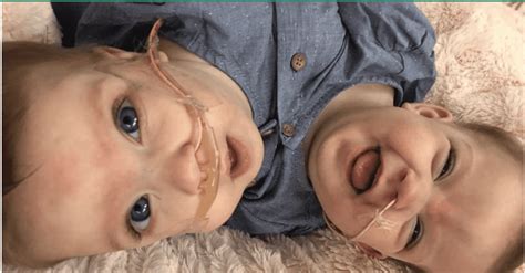 An 11 Hour Surgery Successfully Separates Conjoined Twins “locked In An