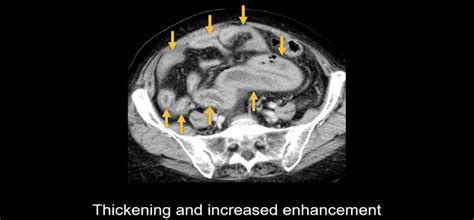 Abdominal CT Bowel Perforation LITFL Radiology Library