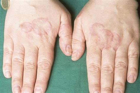 In Most Cases Treatment Of Granuloma Annulare Is Not Needed Because