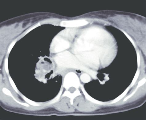 Chest Ct Scan Shows The En Largement Of Peribronchial Lymph Node In The