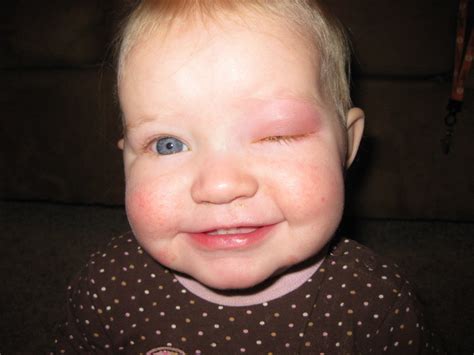 How To Treat Pink Eye With Photos Hubpages