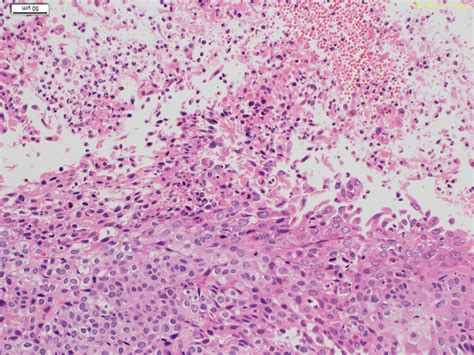 尿細胞診-コンタミ例-① - 日本臨床細胞学会東海連合会日本臨床 ...