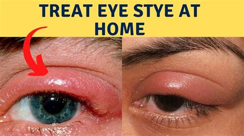 How To Cure An Eye Infection Naturally Get Rid Of Eye Stye At Home
