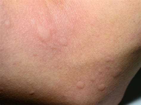 Symptoms Of An Iodine Allergy Livestrongcom
