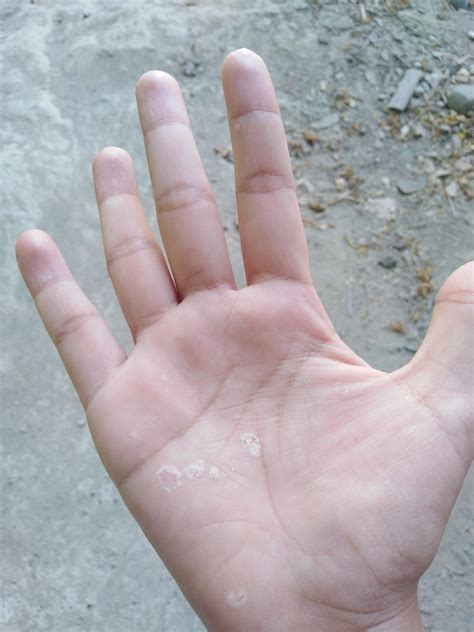 Skin Peeling on palms. This never happenes to me before. I already ...