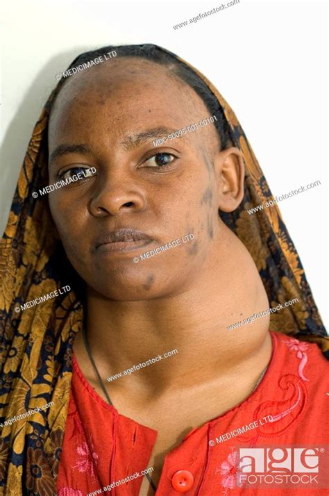 A Woman With A Large Goitre Enlarged Thyroid Gland This Can Arise Due