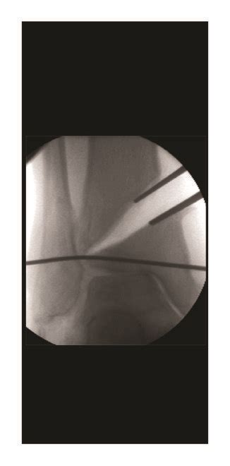 Distal Tibial Oblique Osteotomy Dtoo Download Scientific Diagram