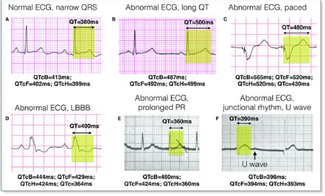 Examples Of Qt Measurement And Correction Qtc Ecg Strips From Lead