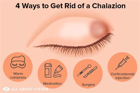 What Is A Chalazion Bump On Eyelid