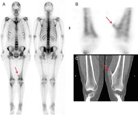 Osteoid Osteoma A 12 Year Old Girl With Left Shoulder Pain Planar A