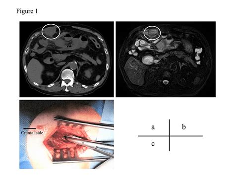 cureus recurrent primary abdominal wall abscess a case report and review of the literature