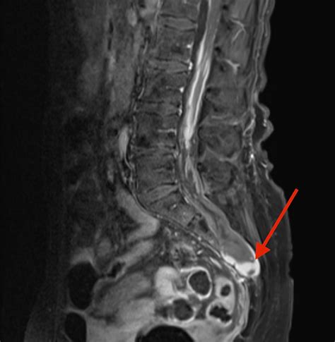 Cureus Tarlov Cyst Rupture And Intradural Hemorrhage Mimicking