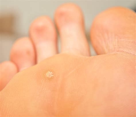 Parkdale Foot Clinic Common Foot Problems Warts And Papillomas