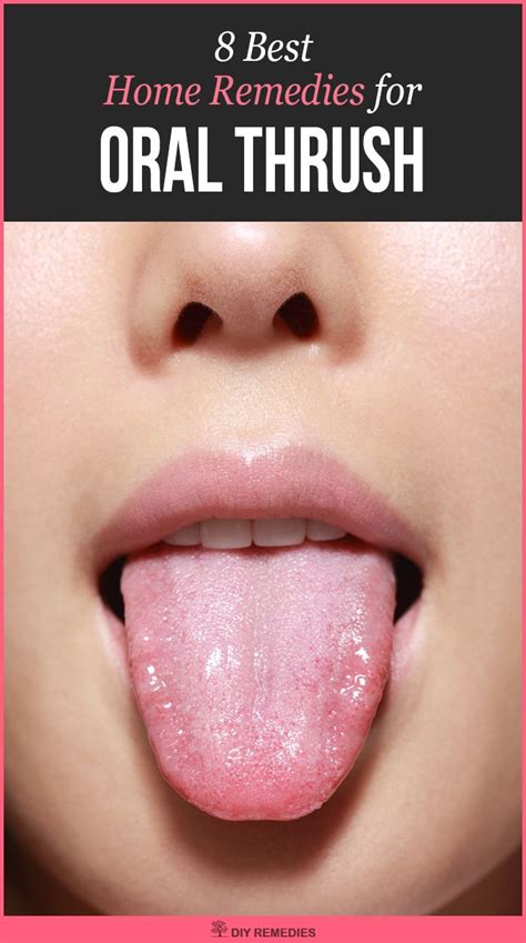 Home Remedies For Oral Thrush Here Are Some Best Natural Remedies That
