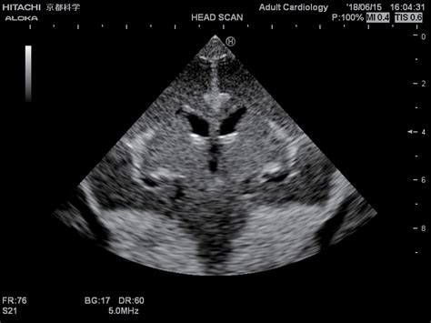 Ultrasound Neonatal Head Phantom At Imaging Solutions Your Single