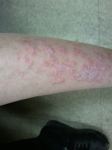 Itchy Rash On Lower Legs Pictures Photos