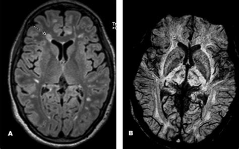 Mri Of An Ms Patient A Flair Image Demonstrating A Pv White Matter