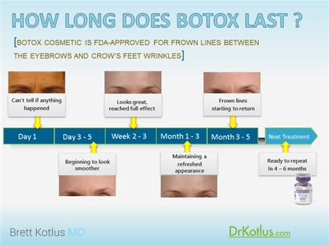 How Long Does Botox Last Dr Brett Kotlus Cosmetic Oculoplastic