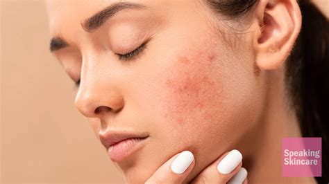 Understanding Skin Inflammation Causes Symptoms And Effective