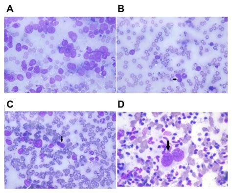 Cytology Of Ductal Carcinoma Of Breast Showing Benign Pairs And