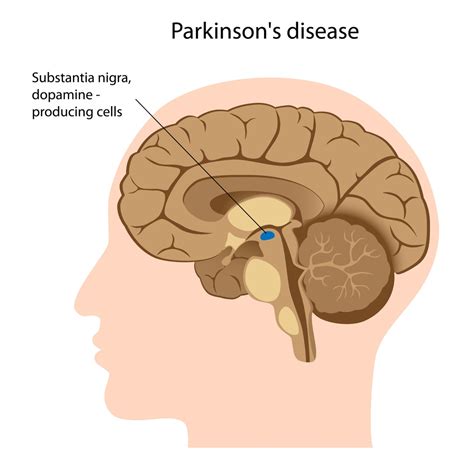 Parkinson’s Disease Stemcellreference