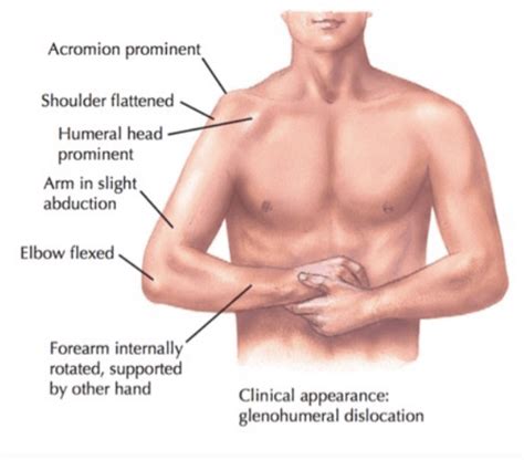 Emergency Medicine Educationem3am Anterior Shoulder Dislocation