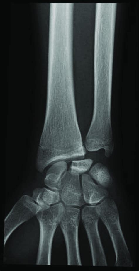 Frontal Radiograph Of The Left Wrist Before Hbot There Are Diffuse