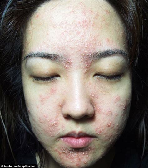 singapore beauty blogger bun bun suffers horrific skin reaction to spa facial treatment