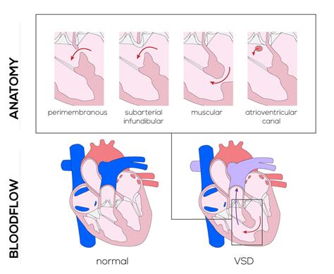 Heart Defects Ventricular Septal Defect Atrial Septal Defect Cleft Vrogue