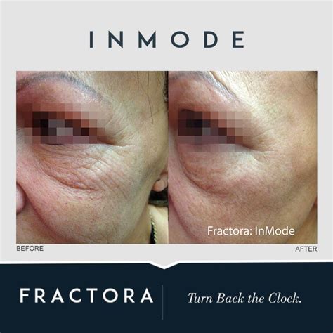 Files Categories Fractora Facial Procedure Skin Rejuvenation