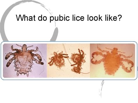 Long Term Effects Of Pubic Lice Information Statement
