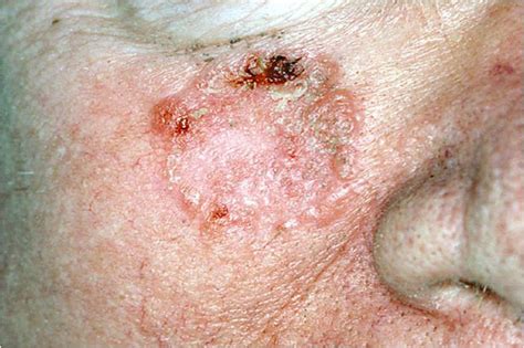 What Does Skin Cancer Look Like A Visual Guide To Warning Signs Allure
