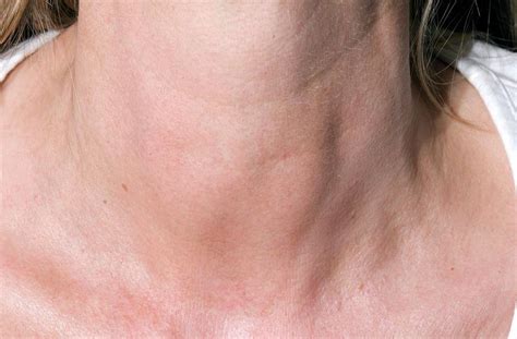 Thyroiditis Swollen Thyroids In Neck Photograph By Dr P Marazzi