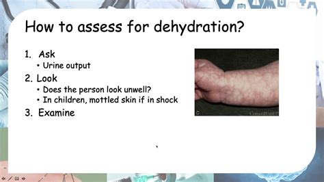 How To Assess For Dehydration Hydration Status Youtube