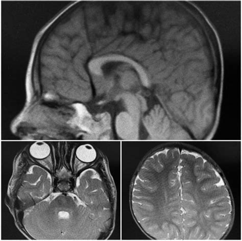 Brain Imaging Mri Shows Evidence Of Mild Cerebral Atrophy And Mild