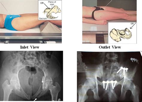 Pelvis Inletoutlet View Pelvis Inlet Diagnostic Imaging