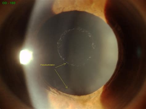 Sonoran Desert Eye Center Pseudoexfoliation Glaucoma