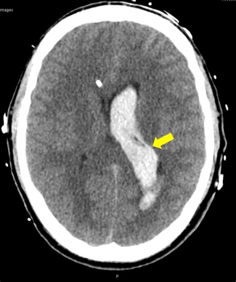 Cureus Sex Drugs And Seizures Subarachnoid Hemorrhage In A Young