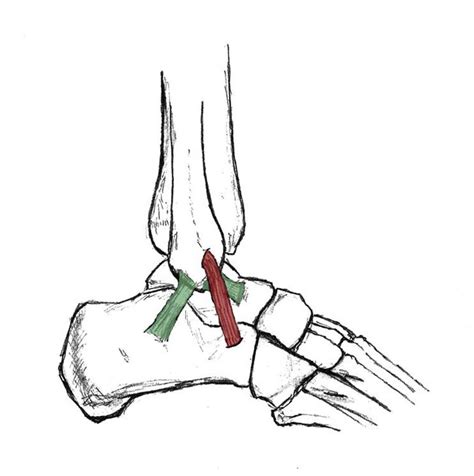 In this video i discuss ligaments, what are ligaments and the functions of ligaments. Technique for Single-Graft Lateral Ankle Stabilization: A ...
