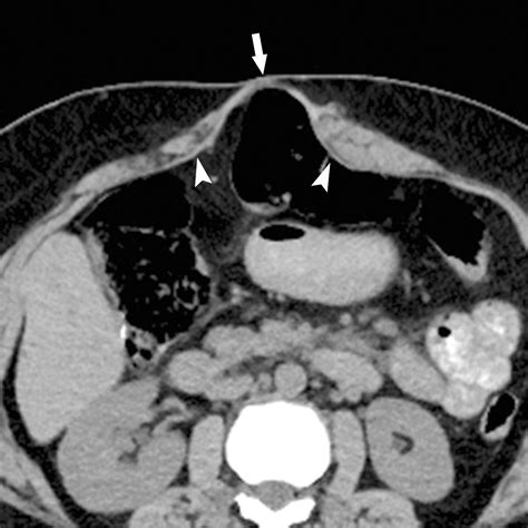 Imaging And Treatment Of Complications Of Abdominal And Pelvic Mesh