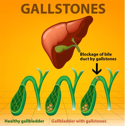 Diet For Gallstones Diet For Gallstones Nutritiousdiet For Gallstones