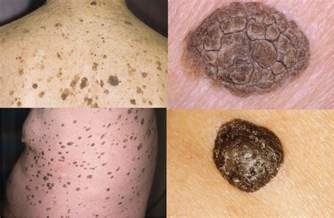 Skin Lesions Cancer